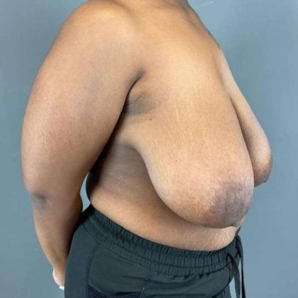 Breast Reduction Before & After Patient #828