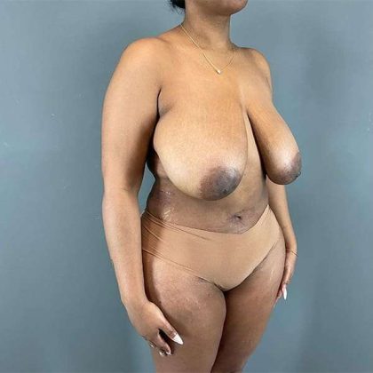 Breast Reduction Before & After Patient #839