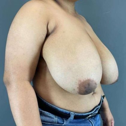 Breast Reduction Before & After Patient #850