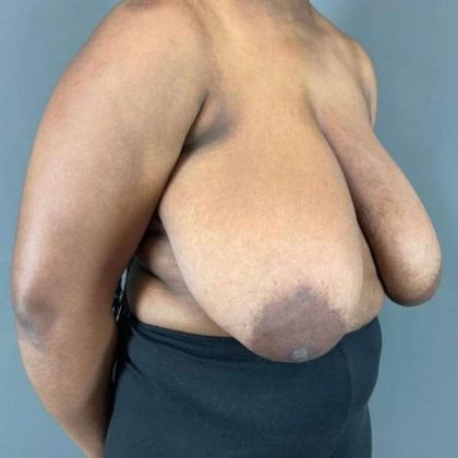 Breast Reduction Before & After Patient #861