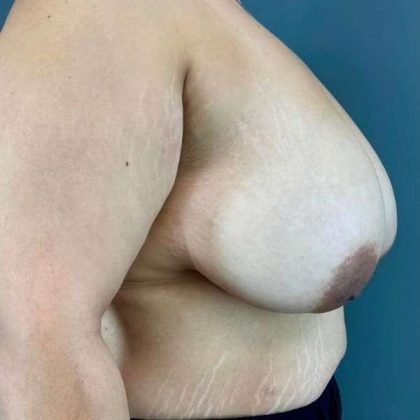 Breast Reduction Before & After Patient #872