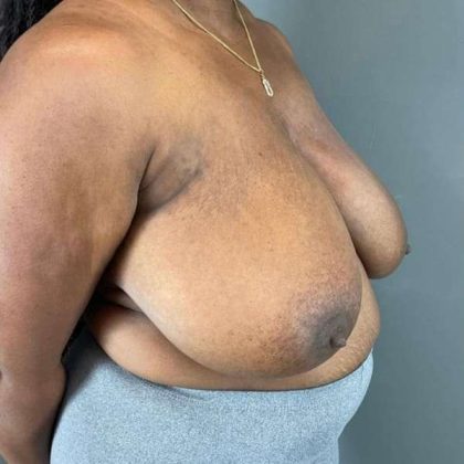 Breast Reduction Before & After Patient #883