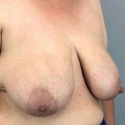 Breast Reduction Before & After Patient #894