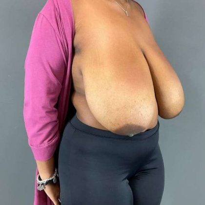 Breast Reduction Before & After Patient #905