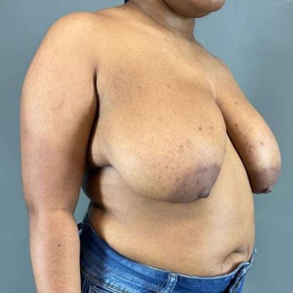 Breast Reduction Before & After Patient #916