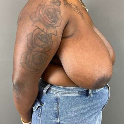 Breast Reduction Before & After Patient #938