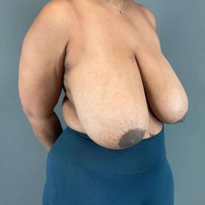 Breast Reduction Before & After Patient #967