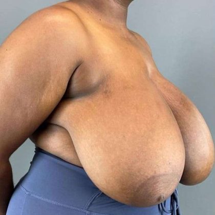 Breast Reduction Before & After Patient #978