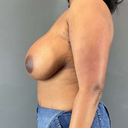Breast Reduction Before & After Patient #987