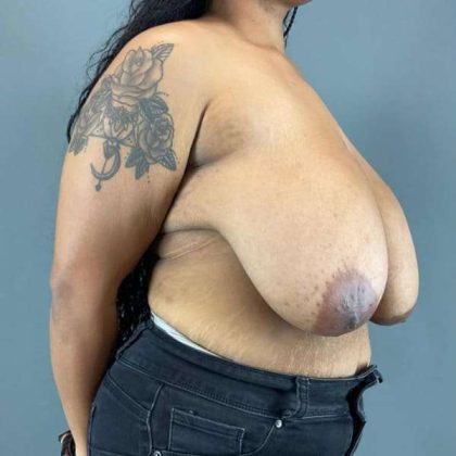 Breast Reduction Before & After Patient #998
