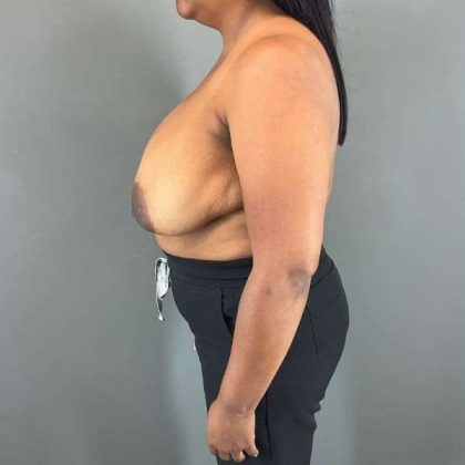 Breast Reduction Before & After Patient #1007