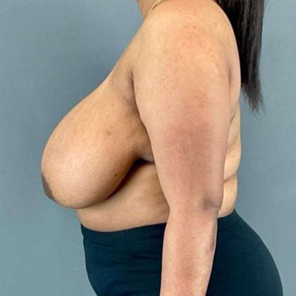 Breast Reduction Before & After Patient #1018