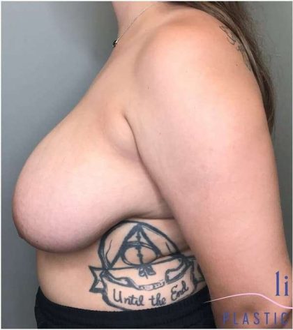 Breast Reduction Before & After Patient #1029