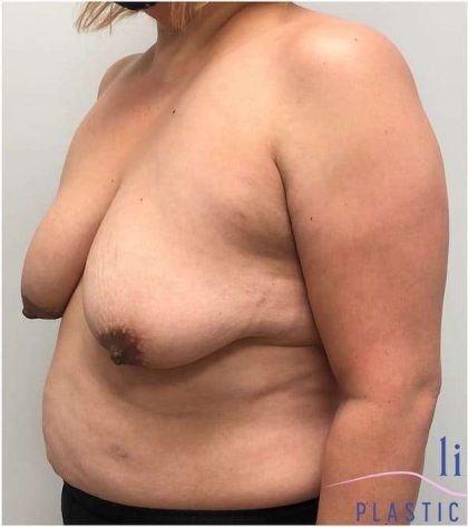 Breast Lift Before & After Patient #1040