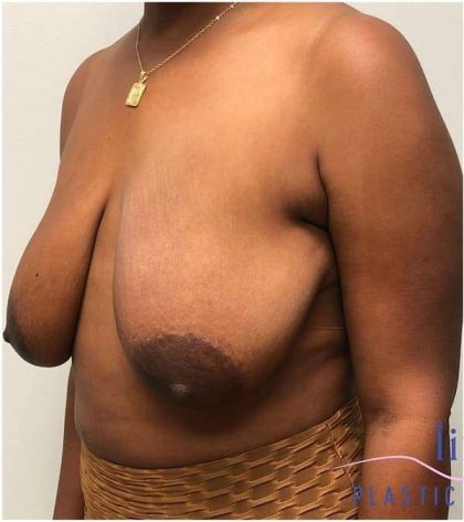 Breast Lift Before & After Patient #1051