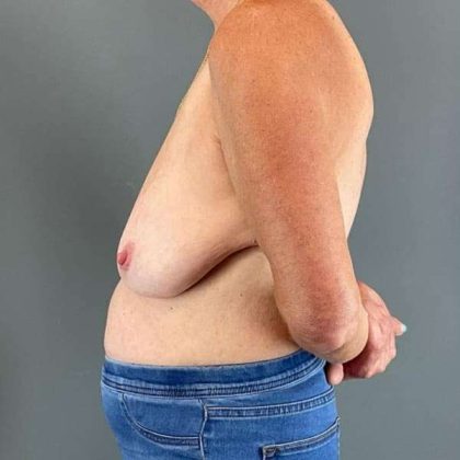 Breast Lift Before & After Patient #1062