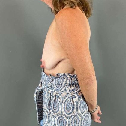 Breast Lift Before & After Patient #1073