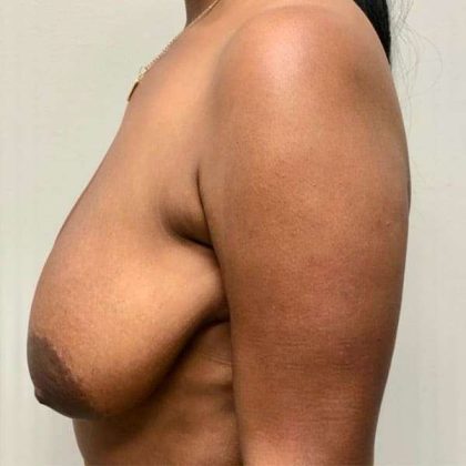 Breast Lift Before & After Patient #1084