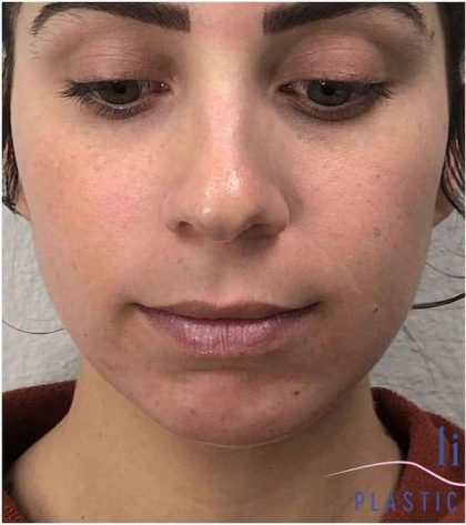 Injectables&Fillers Before & After Patient #125