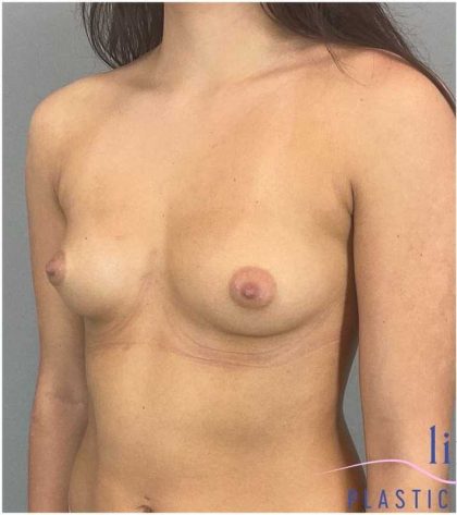 Breast Augmentation Before & After Patient #1252
