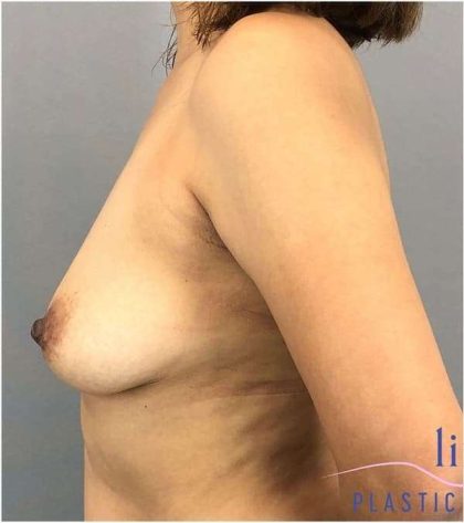 Breast Augmentation Before & After Patient #1274