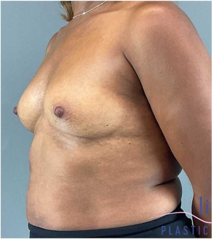 Breast Augmentation Before & After Patient #1307