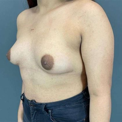 Breast Augmentation Before & After Patient #1318