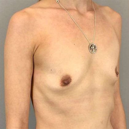 Breast Augmentation Before & After Patient #1329