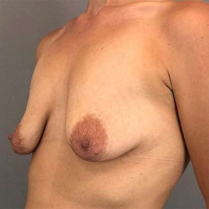 Breast Augmentation Before & After Patient #1351