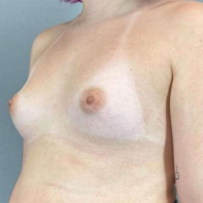 Breast Augmentation Before & After Patient #1362