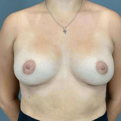 Breast Augmentation Before & After Patient #1395