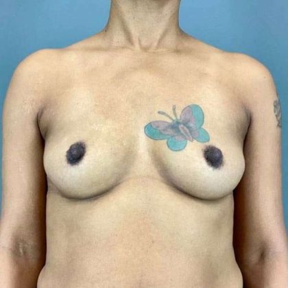 Breast Augmentation Before & After Patient #1428