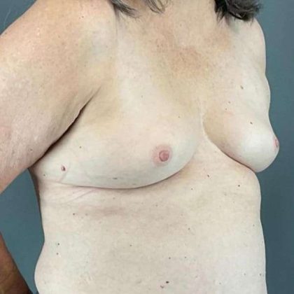 Breast Augmentation Before & After Patient #1450
