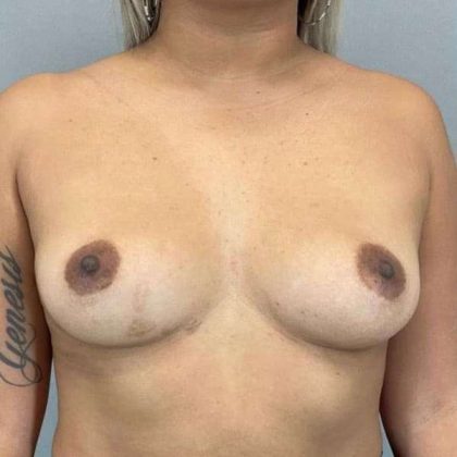 Breast Augmentation Before & After Patient #1483
