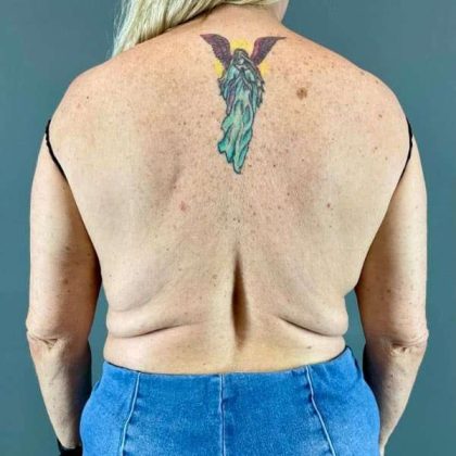 Back Lift Before & After Patient #287