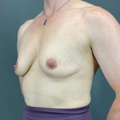 Breast Augmentation Before & After Patient #1547