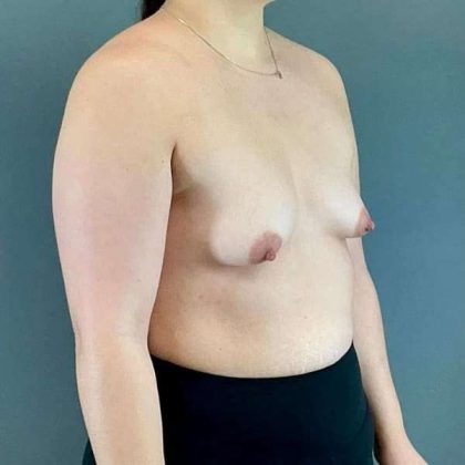 Breast Augmentation Before & After Patient #1591