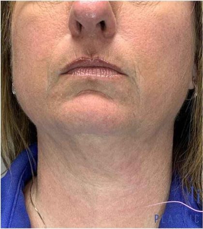 Necktite Before & After Patient #1624