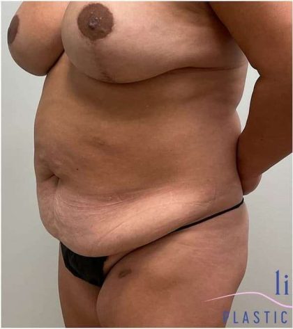 Tummy Tuck Before & After Patient #303