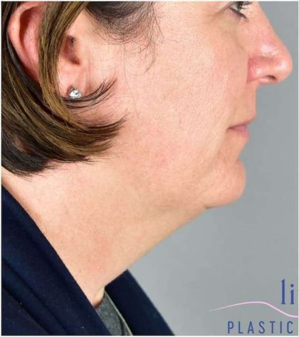 Necktite Before & After Patient #1633