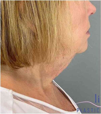Neck Lift Before & After Patient #1649