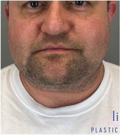 Neck Lift Before & After Patient #1660