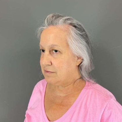 Neck Lift Before & After Patient #1671