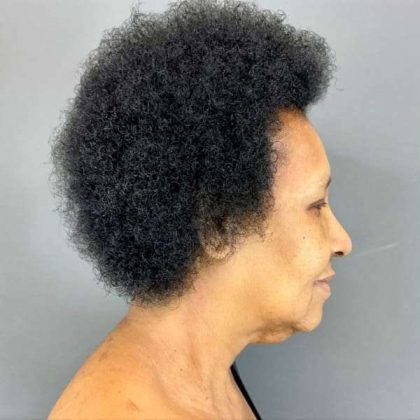 Neck Lift Before & After Patient #1685