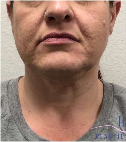 Neck Lift Before & After Patient #1696