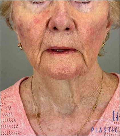 Facelift Before & After Patient #1703