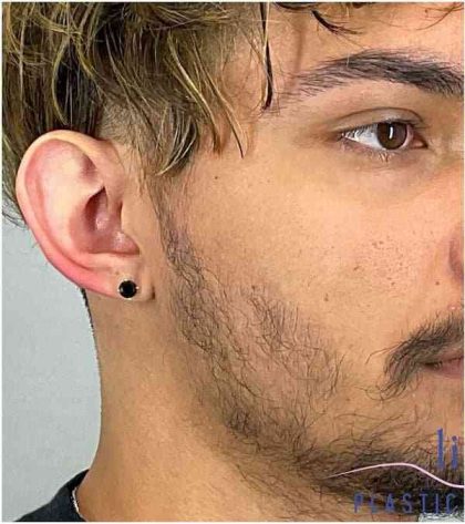 Ear Surgery Before & After Patient #1715