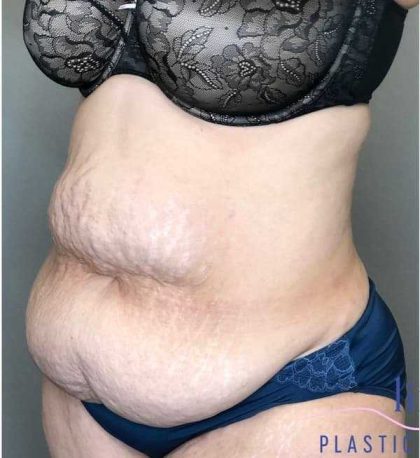 Tummy Tuck Before & After Patient #314
