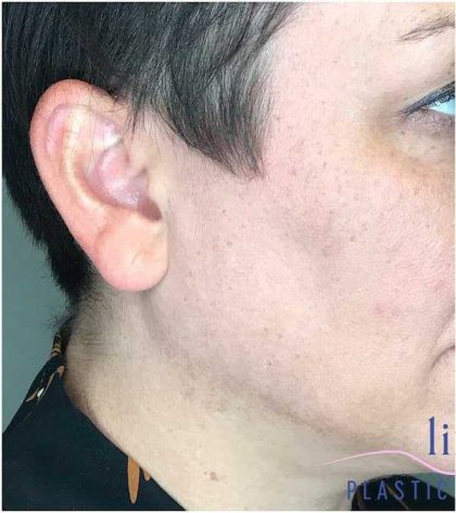 Ear Surgery Before & After Patient #1724