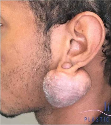 Ear Surgery Before & After Patient #1731